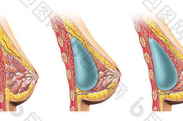 女人乳房植入物交叉部分比较图胸肌肉
