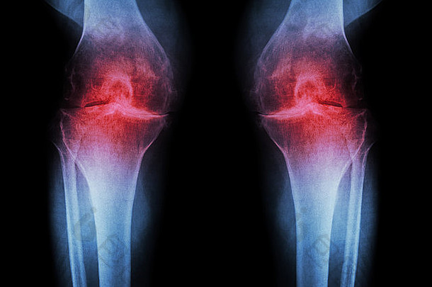 骨关节炎膝盖膝盖电影x射线膝盖关节炎膝盖联合狭窄的膝盖联合空间医疗