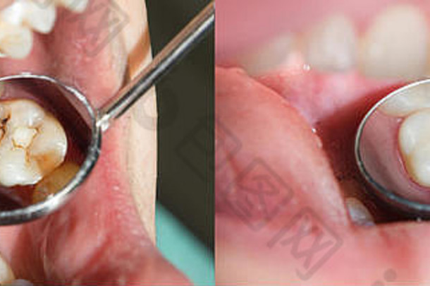 人类牙齿特写镜头恢复填充概念审美牙科
