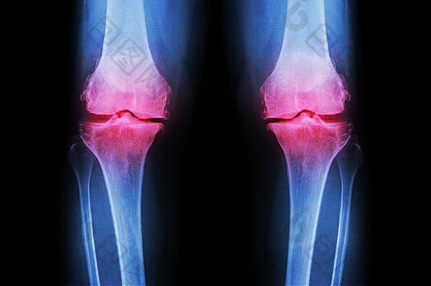 骨关节炎膝盖膝盖电影x射线膝盖前面视图显示狭窄的联合空间联合软骨损失骨学