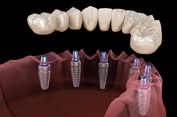下颌骨假体全部在6个系统上，由种植体支撑。人体牙齿和假牙概念的医学精确3D图解