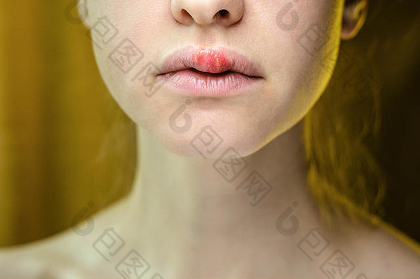 疱疹上唇年轻的女人医疗背景年轻的美丽的女孩疱疹口唇疱疹单纯形病毒