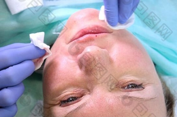 美容师医生为一个女人的脸做美容注射，注射透明质酸。美容院里的女人。整形外科诊所