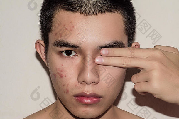 年轻的男人。治疗痤疮丘疹脸皮肤治疗伤疤皱纹痤疮删除点皮肤