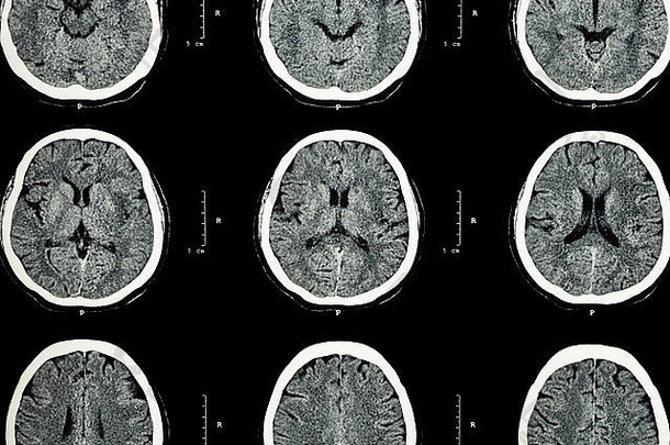 脑部CT扫描显示正常脑部（神经背景）