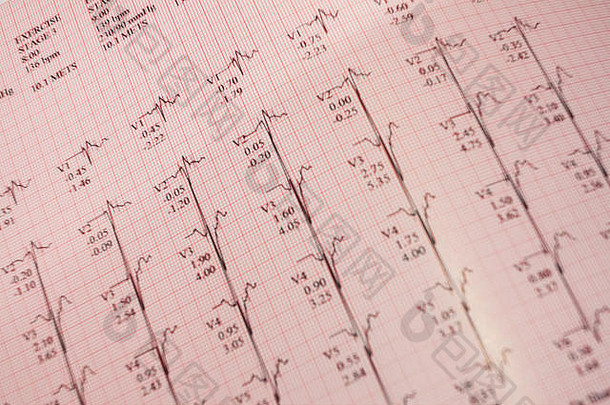 跑步机训练后的心电图打印输出