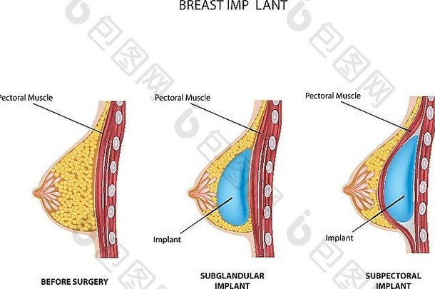 乳房植入物整形手术示意图