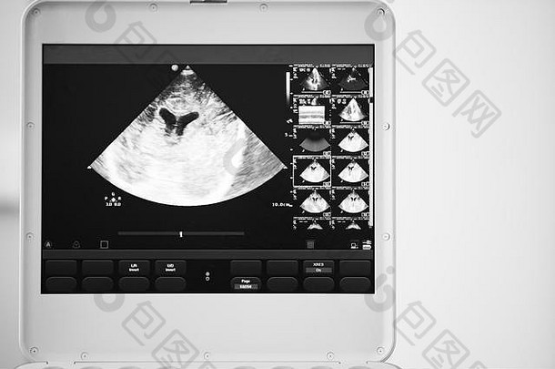 在超声波设备的屏幕上是通过脑室的脑部扫描的灰度图像。黑白图像。