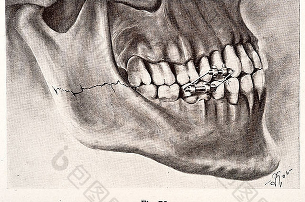 插图人类牙齿版权