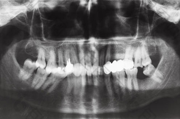 前面视图人类大白鲨牙科皇冠针牙齿x射线图像