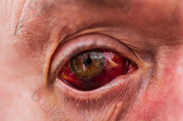一次工业事故导致眼睛充血。瞳孔的切口是可见的，可能导致失明
