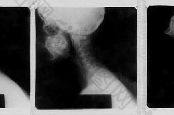 x射线图像人类颈脊柱