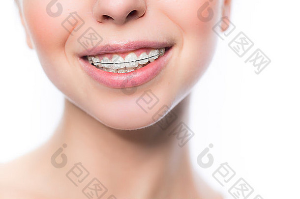 女人牙齿牙套