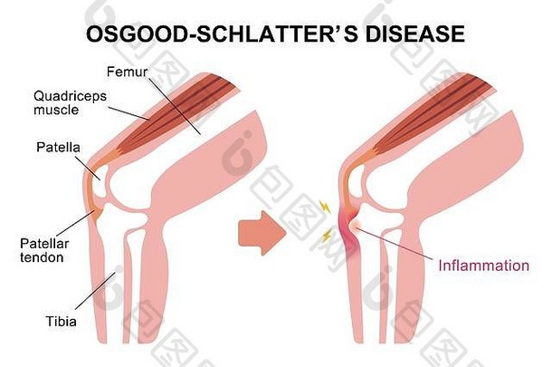 Osgood Schlater病（膝关节疾病）插图
