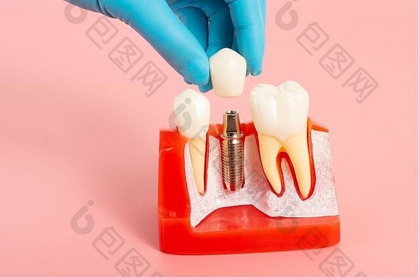 由硅酮制成的牙科植入物示例演示了牙科植入物的组件。当插入患者牙龈时，患者可以