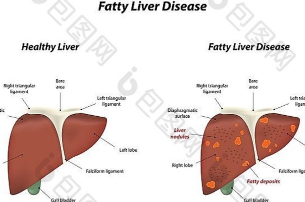 高脂肪的肝疾病