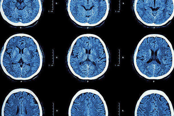 扫描大脑显示正常的大脑神经系统背景