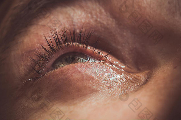 一名男子用鲜红的动脉滴眼液打开人眼，以改善近距离视力。眼球发炎和发红。瞳孔，虹膜，睫毛