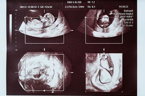 婴儿超声波检查。妊娠20周。拼贴，不同角度。