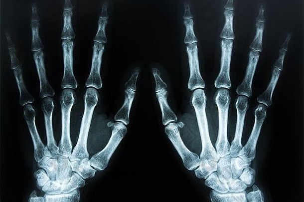 手部X线扫描