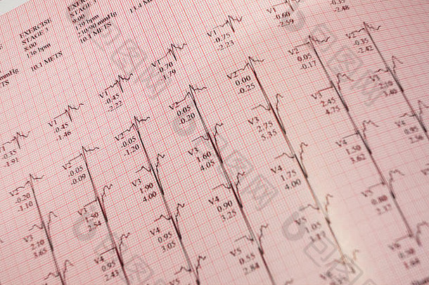 跑步机训练后的心电图打印输出
