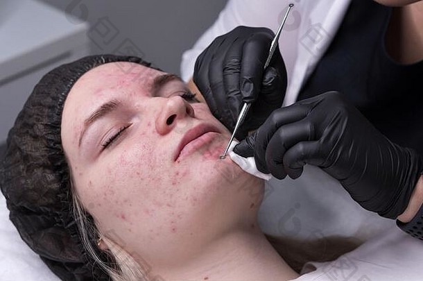 美容师在美容中心用钢制工具清洁黑头和粉刺的皮<strong>肤</strong>。痤疮治疗。美容和专业皮<strong>肤</strong>护理。