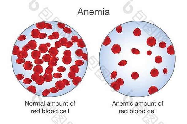 区别贫血量红色的血细胞正常的