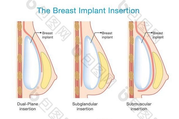 乳房植入术