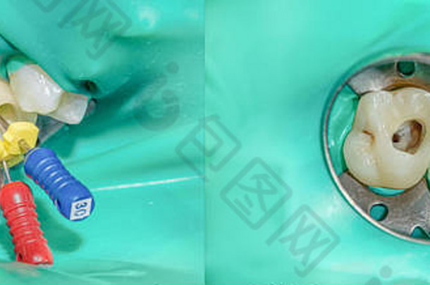 照片牙髓学的治疗牙科运河较低的摩尔永久牙摩尔牙髓学的文件顶点定位器牙夹附加