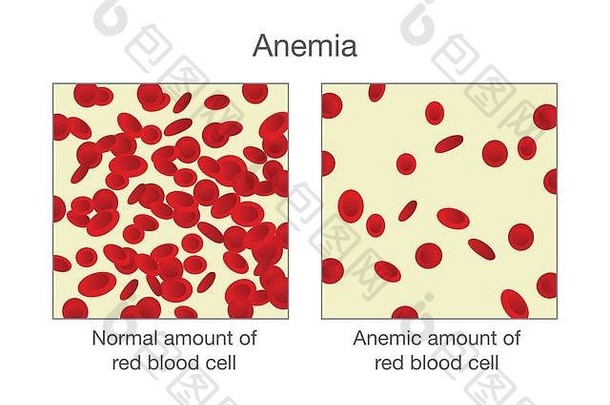 区别正常的量红色的血细胞贫血