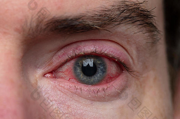 关闭严重的充血眼睛睑缘炎结膜炎条件