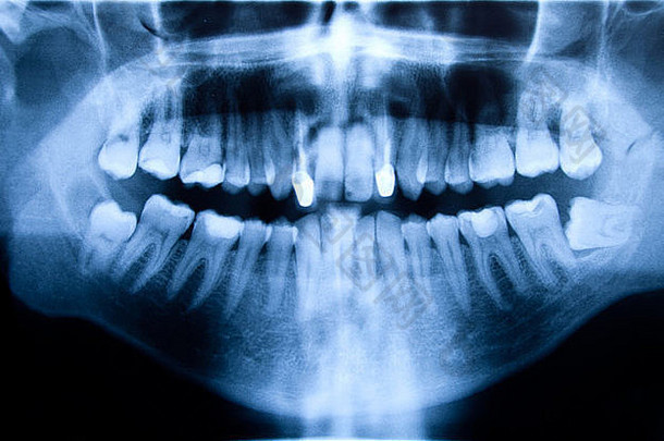 牙科x射线