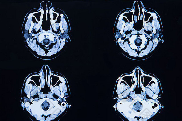 图片计算机化的断层摄影术大脑头骨