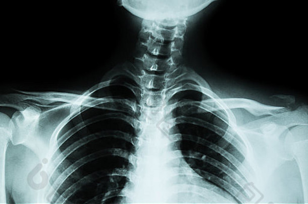 电影x射线锁骨前面视图显示骨折远端左锁骨