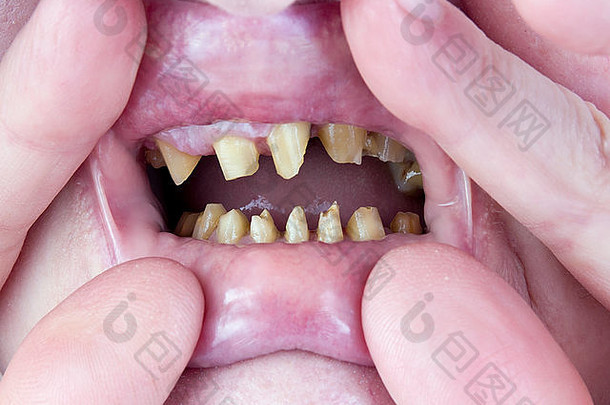 牙齿上了年纪的女人加工过的减少安装陶瓷人工假牙