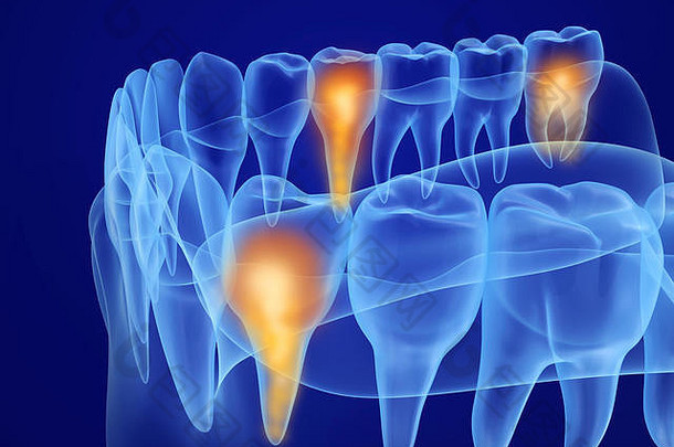 口口香糖牙齿x光视图医学上准确的牙插图