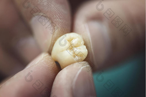 人工牙牙科假肢专家