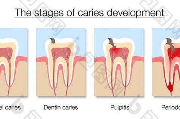 龋齿阶段图表发展牙衰变搪瓷牙质龋齿牙髓炎牙周炎插图白色背景