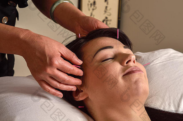 针灸治疗头寺庙年轻的女人形态传统的中国人医学