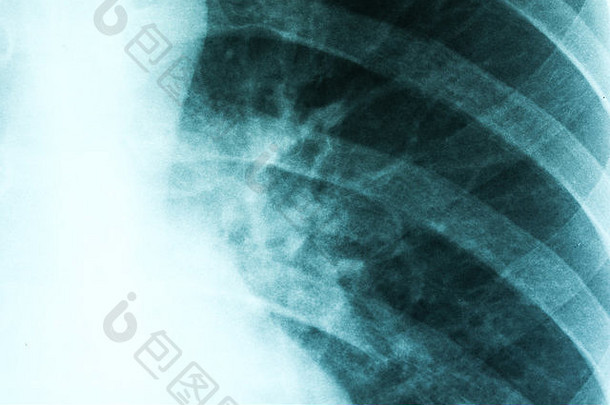 医疗x射线肺炎受感染的肺
