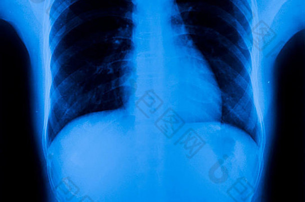 x射线胸部肺