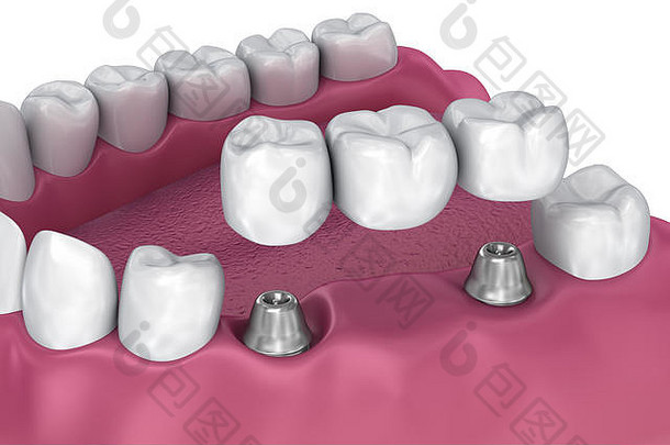 植入物支持固定桥医学上准确的插图