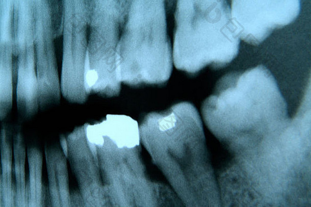 牙科x射线图像显示牙科汞合金