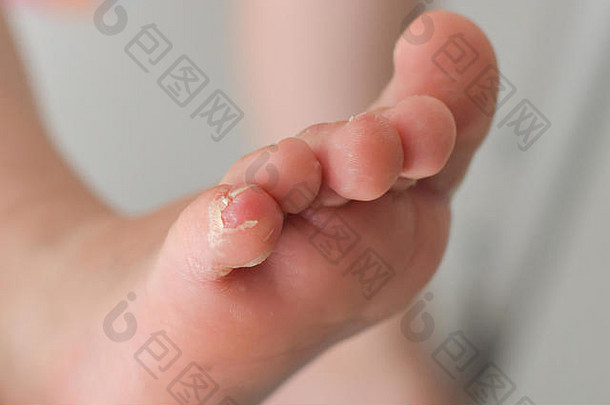 肠病毒脚手口皮肤去皮身体孩子蟑螂病毒