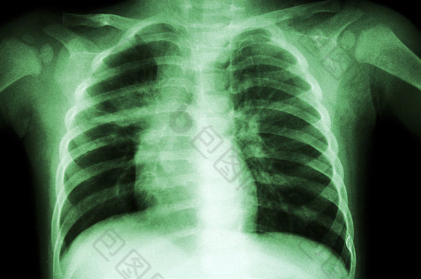 肺肺结核胸部x射线孩子显示不完整的渗透中间肺