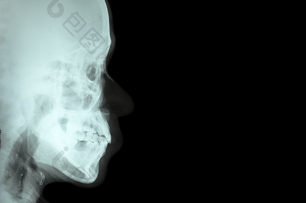 电影x射线横向鼻骨一边视图头骨空白区域一边