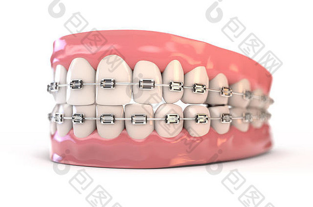 一对上较低的集完美的人类牙齿安装钢牙科牙套孤立的背景渲染