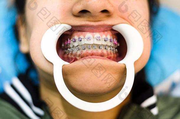 特写镜头年轻的女人的牙齿牙套牵开器口病人牙医