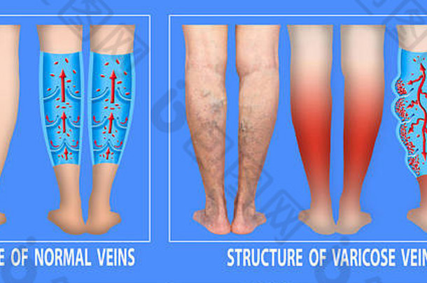 静脉曲张的静脉女高级腿结构正常的静脉曲张的静脉