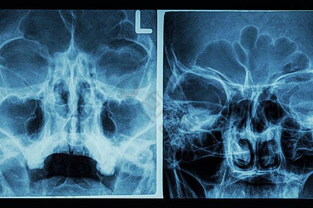 电影x射线鼻侧的窦显示额窦上颌骨窦筛骨窦
